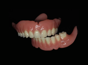 BPS生物功能性义齿